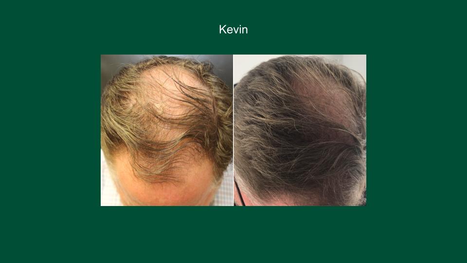 Exosome Hair Restoration Results